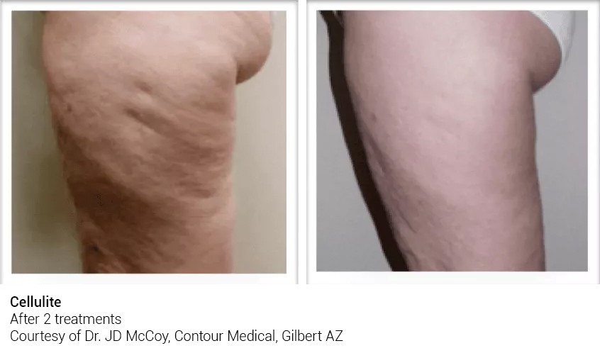 Cellulite Reduction Before and After
