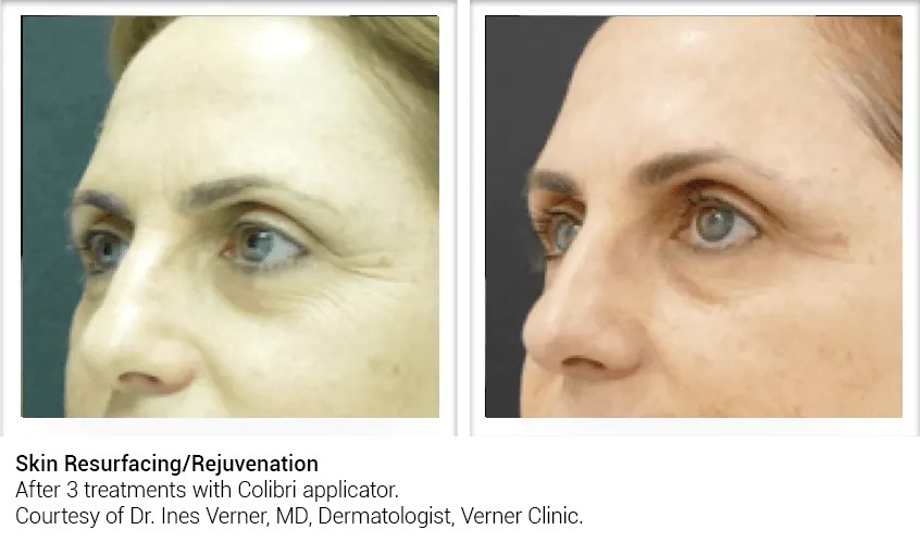 Skin Resurfacing Before and After