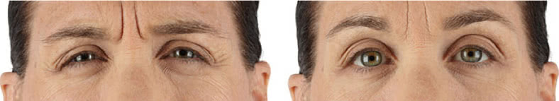 Xeomin Before and After